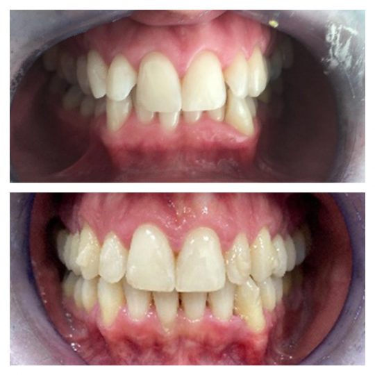 Ortodonzia raddrizamento 2